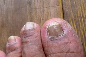 Cum să diagnosticați și să gestionați bolile fungice comune ale picioarelor