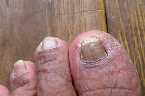 Cum să diagnosticați și să gestionați bolile fungice comune ale picioarelor