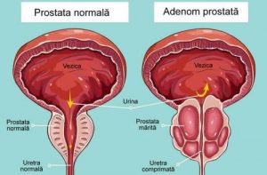 Simptomele problemei prostatice - când să consulti un medic