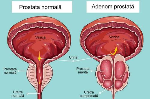 Simptomele problemei prostatice – când să consulti un medic